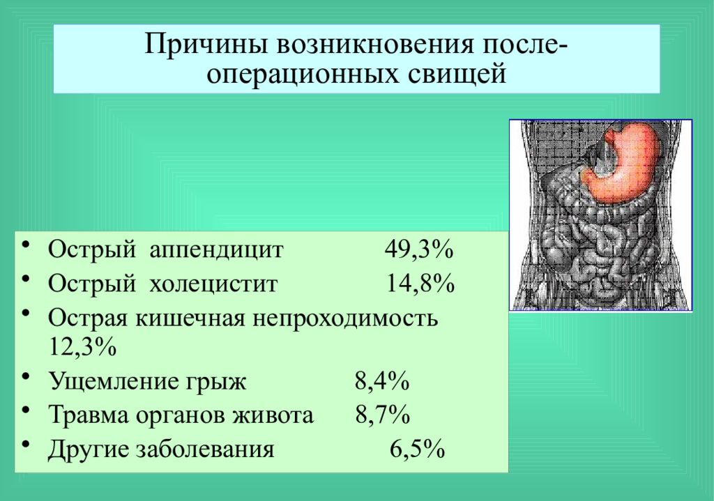 Аппендицит причины. Кишечные свищи причины возникновения. Предпосылки аппендицита. Кишечный свищ после аппендицита.