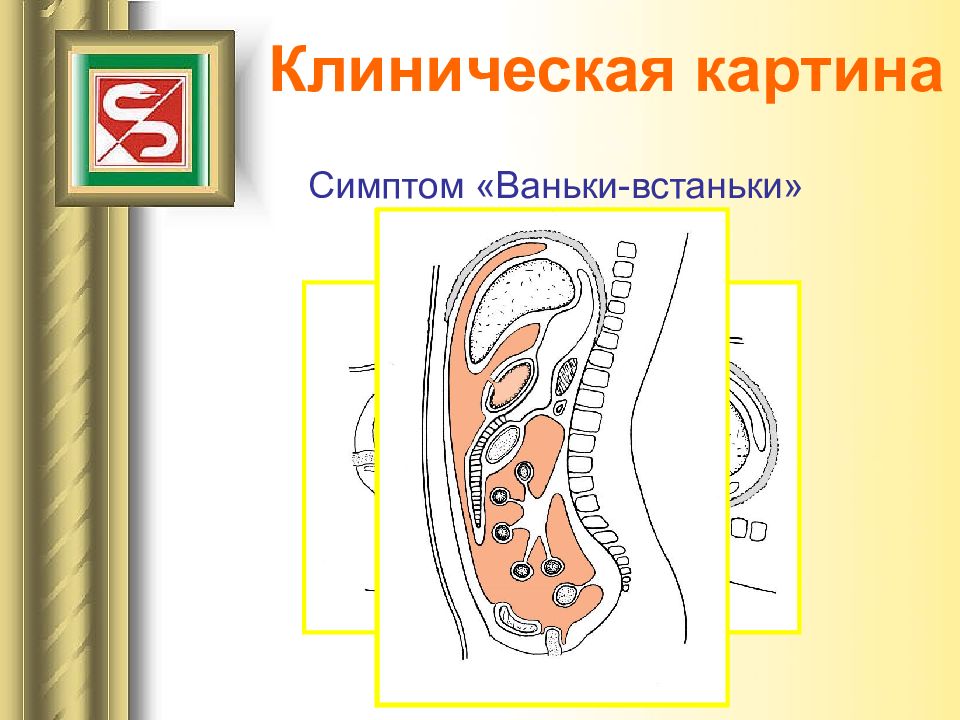 Возникновение сквозного дефекта в стенке полого органа