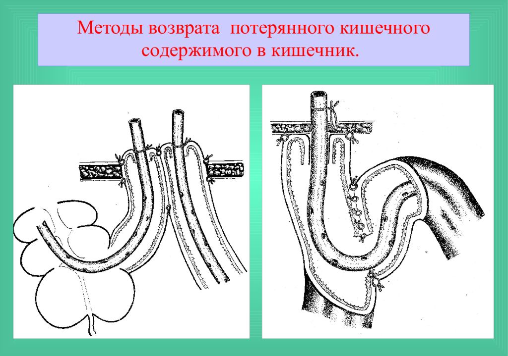 Лечение кишечных свищей