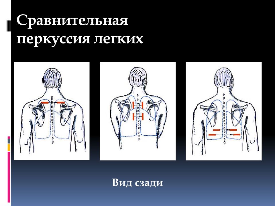 Сравнительная перкуссия. Перкуссия дыхательной системы. Сравнительная перкуссия сбоку. Точки перкуссии легких сзади. Сравнительная перкуссия легких.