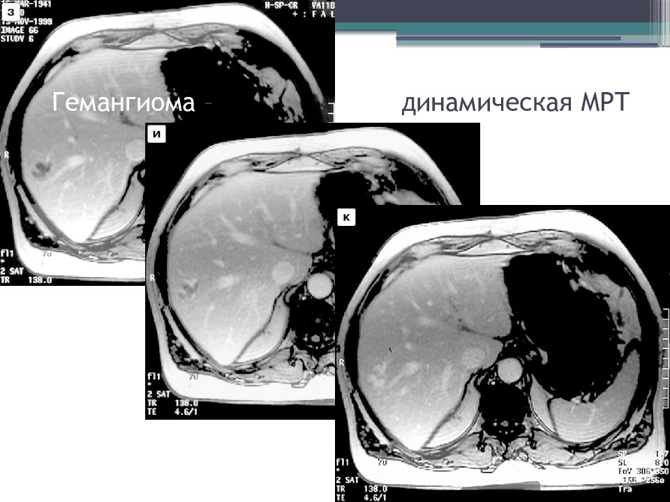 Контраст для мрт. Фазы динамического контрастирования мрт. Гемангиома мягких тканей мрт.