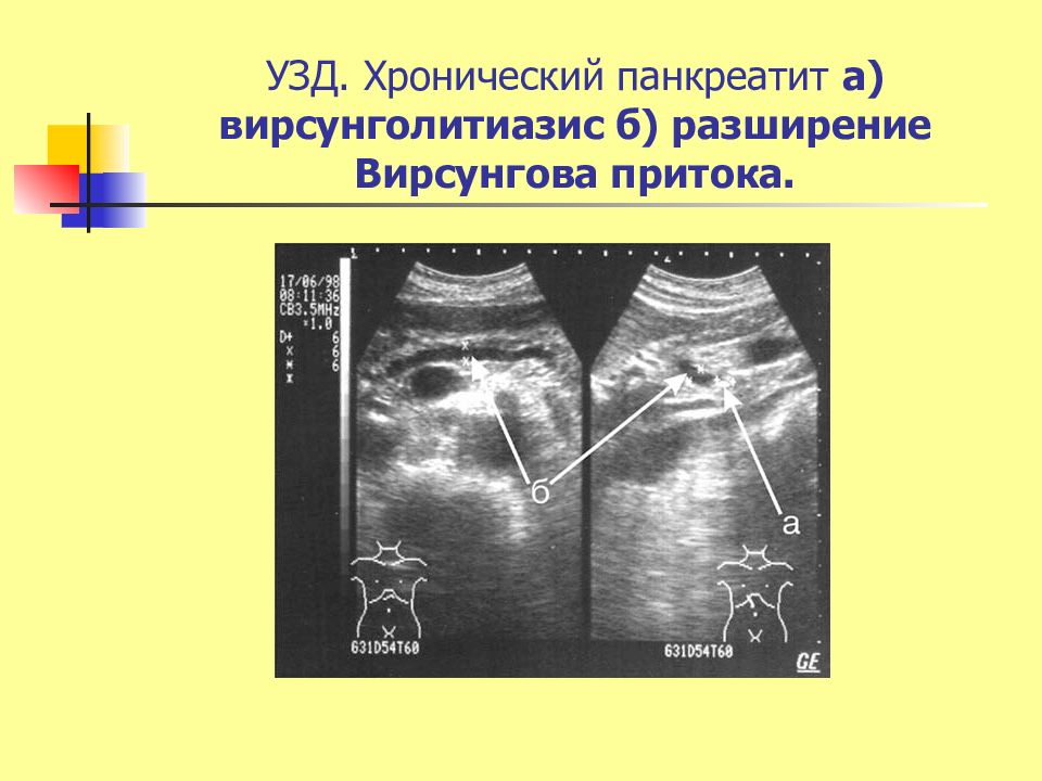 Хронический панкреатит код. Расширение вирсунгова при хроническом панкреатите. Хронический панкреатит держать в Узде.