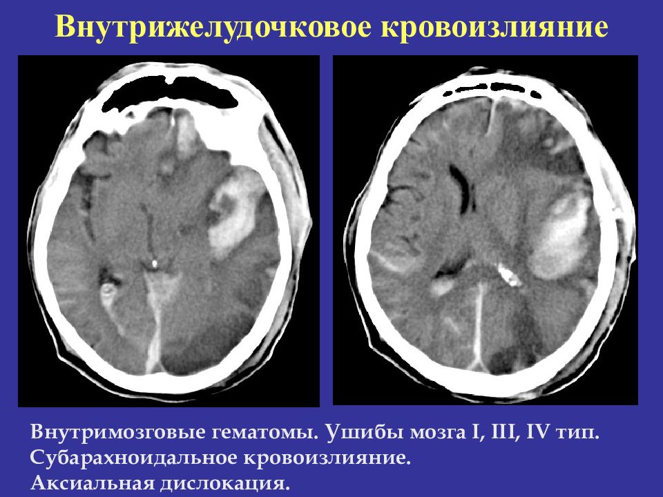 Дислокация мозгах