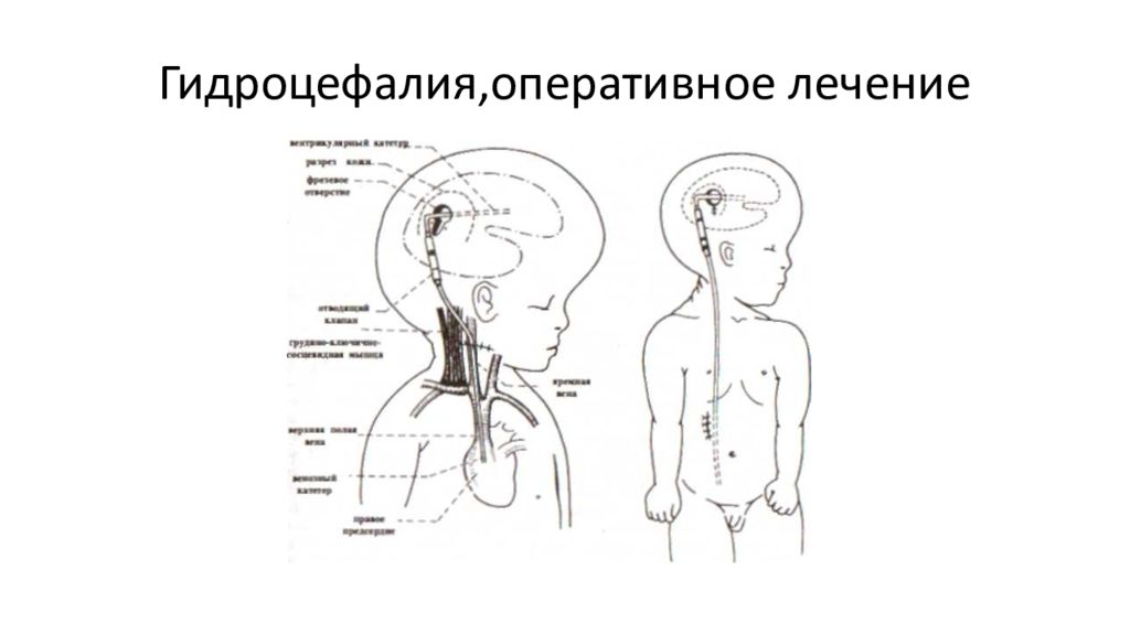 Шунт при гидроцефалии схема