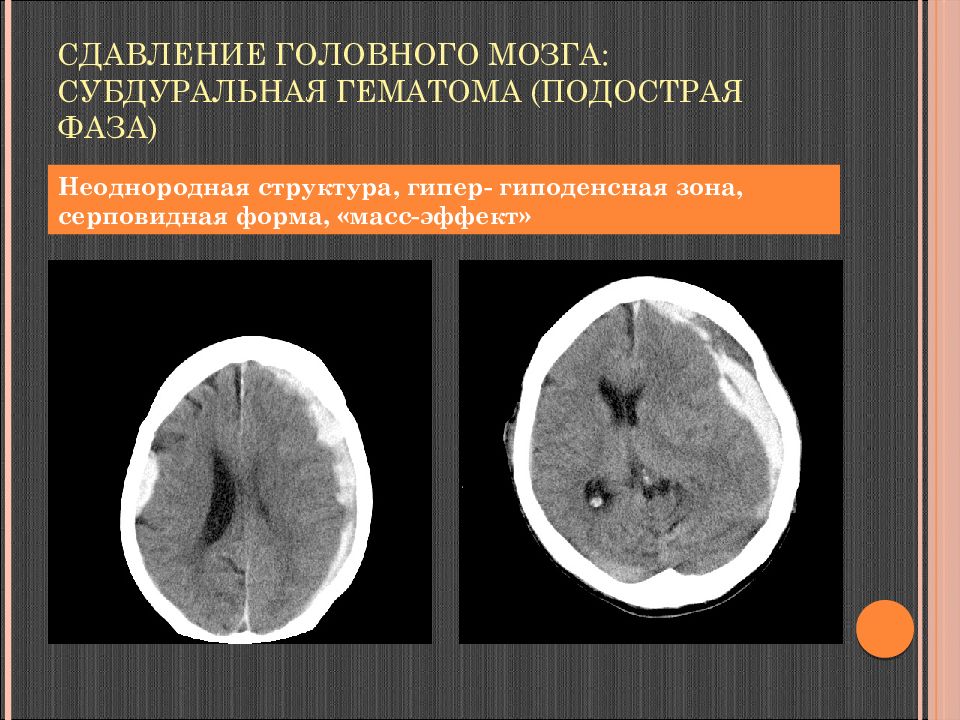 Сдавление головного мозга гематомой. Подострая субдуральная гематома на кт. Подострая гематома на кт головного мозга. Сдавление головного мозга кт.