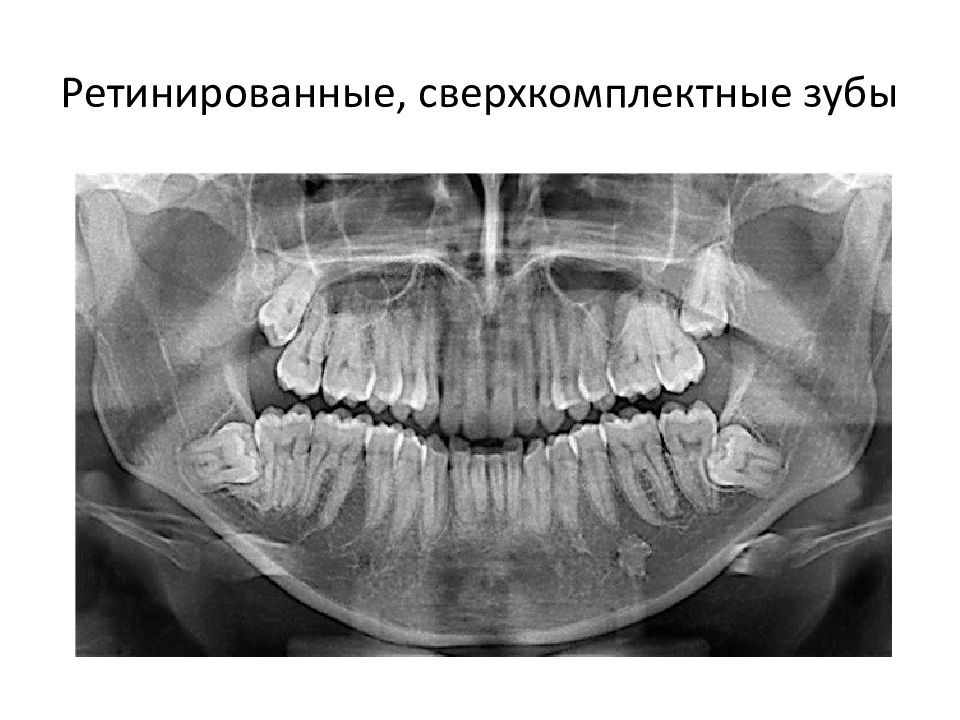 Аномалии удаления. Сверхкомплектные зубы ОПТГ. Сверхкомплектные зубы рентген. Сверзкомплектные щуб ы. Сверх-комлпектыне зубы.