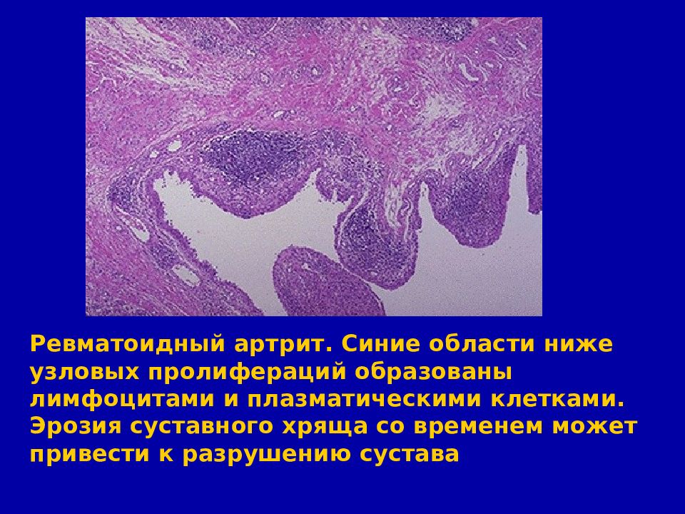 Сосудистая патология. Сердечно-сосудистая патология 23 21. Эрозия суставного хряща. Синеет язык причины сердечно сосудистая патология.