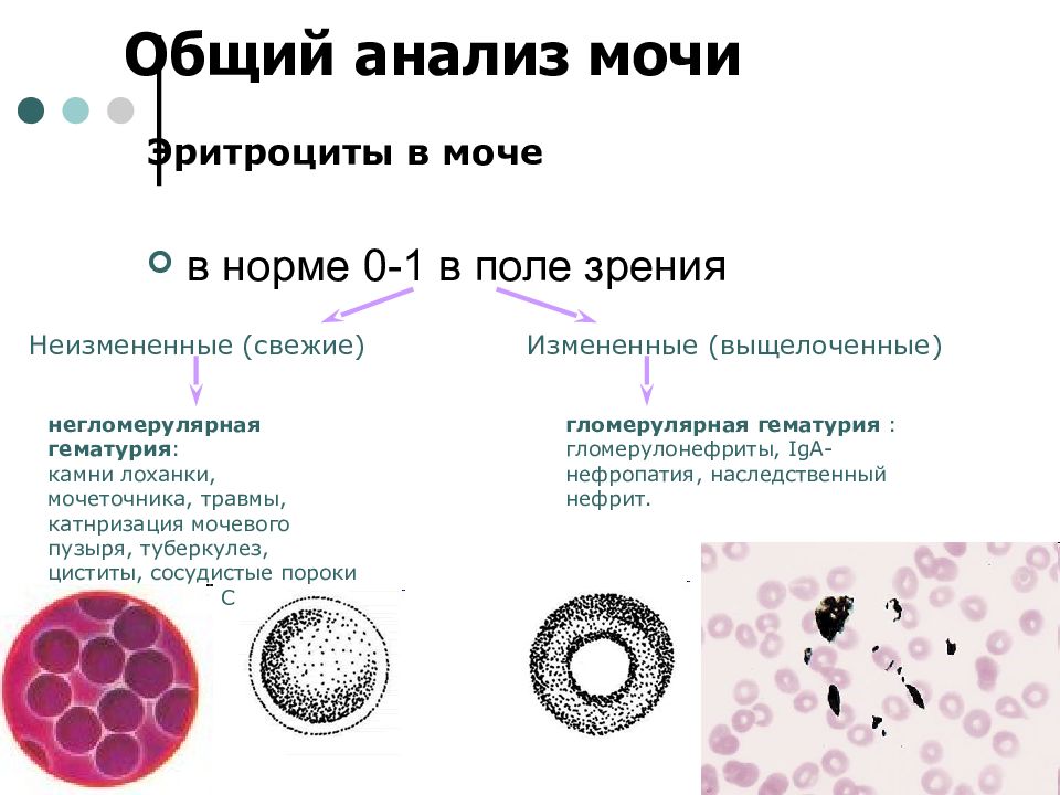 Таблица эритроцитов в моче у женщин. Измененные и неизмененные эритроциты в моче. Выщелоченные эритроциты в моче. Эритроциты в моче свежие и измененные. Свежие и выщелоченные эритроциты в моче.