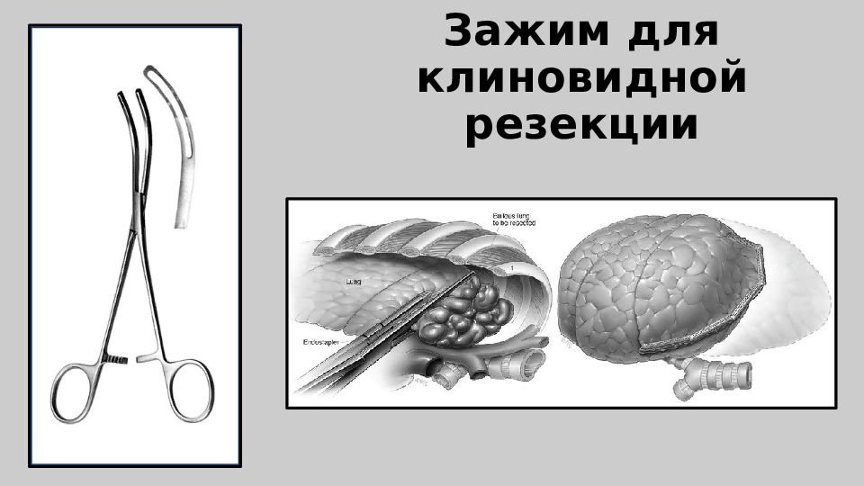 Торакальная хирургия презентация