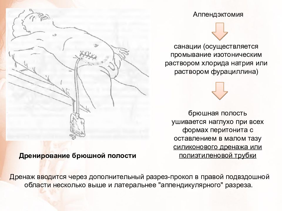 Температура при аппендиците