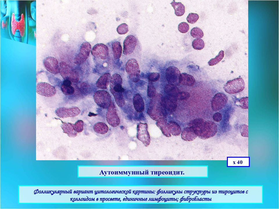 Цитологическая картина аутоиммунного тиреоидита
