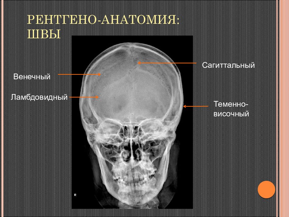 Кт анатомия черепа. Швы черепа анатомия рентген. Венечный Сагиттальный ламбдовидный шов. Череп рентген анатомия. Кости черепа на кт.