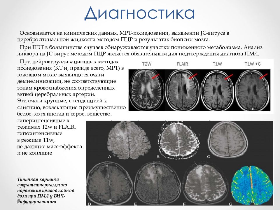 Лейкоэнцефалопатия кт картина