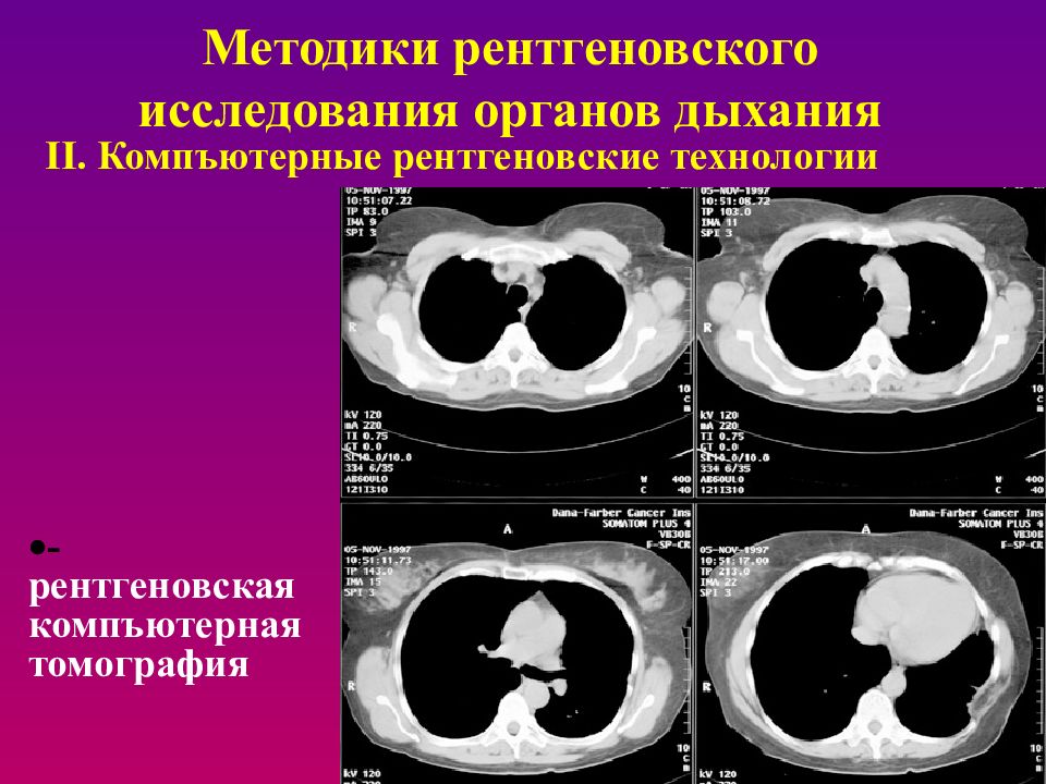 Методы лучевой диагностики органов дыхания презентация