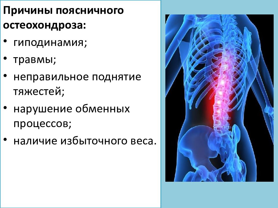 Поясничный остеохондроз