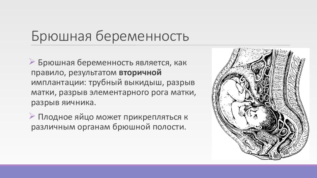 Эктопическая беременность презентация