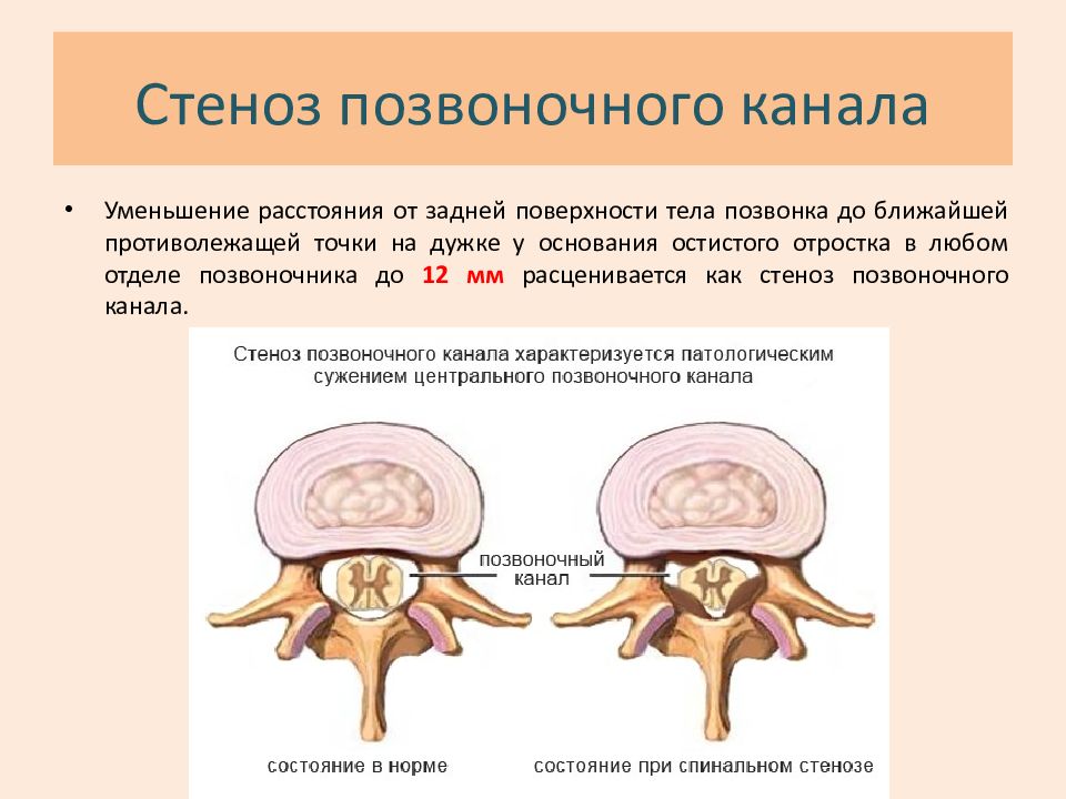 Абсолютный стеноз позвоночного канала