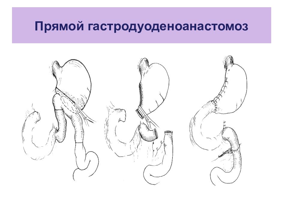 Болезни оперированного желудка презентация