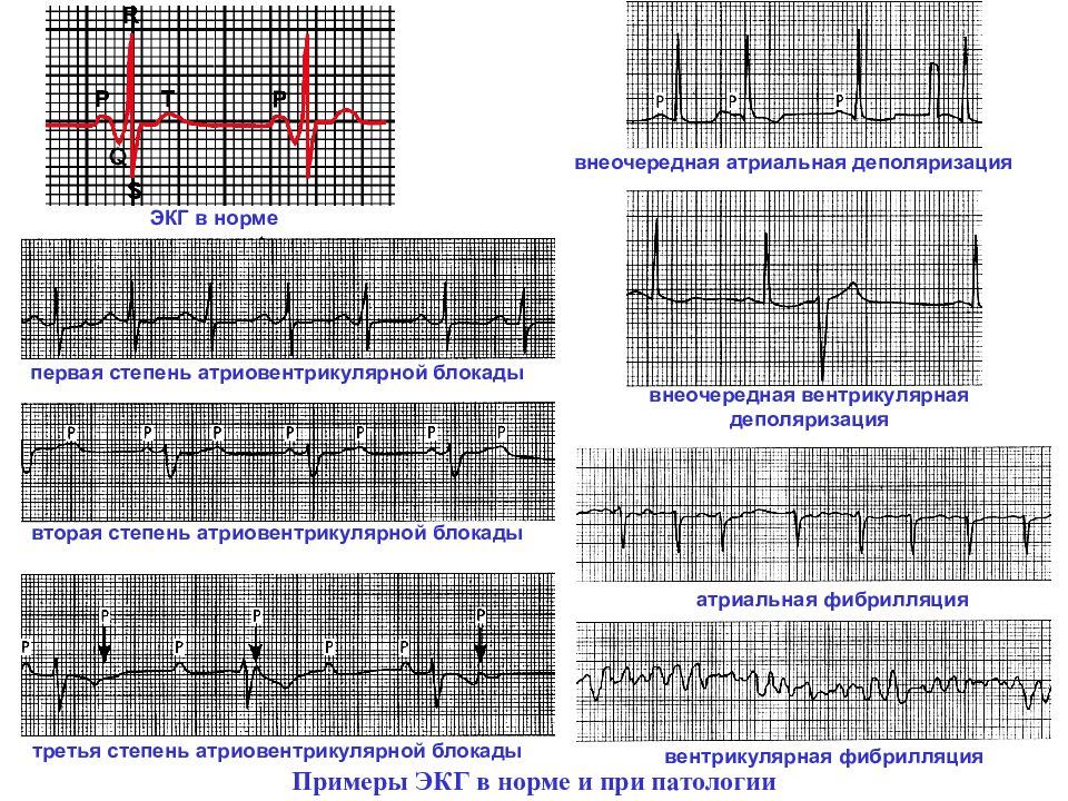 Экг примеры для студентов. ЭКГ диаграмма. Блокады ЭКГ примеры. S Тип ЭКГ. ЭКГ патологии.