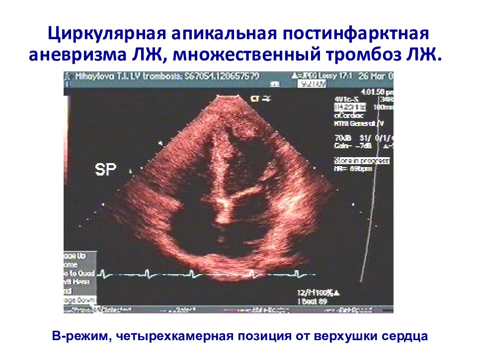 Картине истинной аневризмы в области верхушки миокарда левого желудочка соответствует