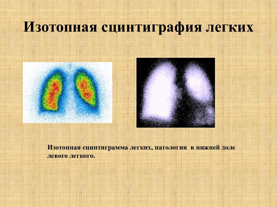 Сцинтиграфия это. Сцинтиграфия легких с изотопами позволяет уточнить состояние. Динамическая сцинтиграфия легких. Сцинтиграфия лёгких с изотопами. Ингаляционная сцинтиграфия легких.