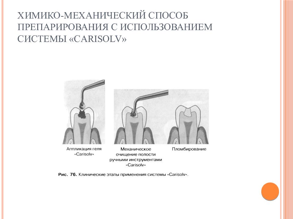 Способы препарирования кариозных полостей. Химико механическая обработка кариозных полостей. Химико-механический метод препарирования твердых тканей. Химико механический метод препарирования твердых тканей зуба. Химико механическое препарирование кариозных.