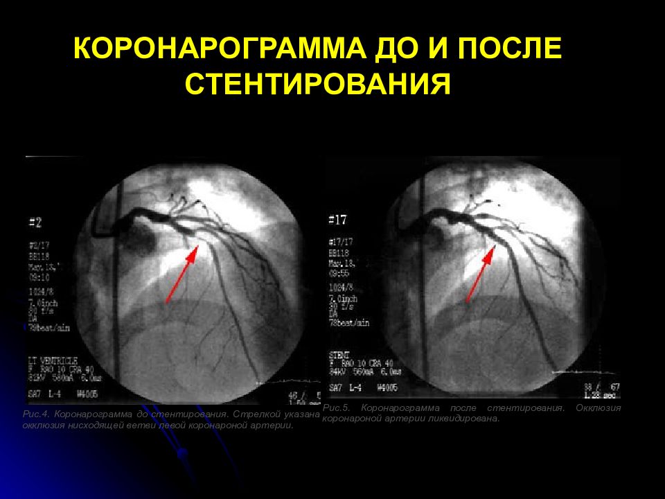 Жизнь после инфаркта и стентирования. Инфаркт миокарда операция стентирование. Инфаркт сердца стентирование. Стентирование сердца при инфаркте миокарда. Рубец на сердце после инфаркта.