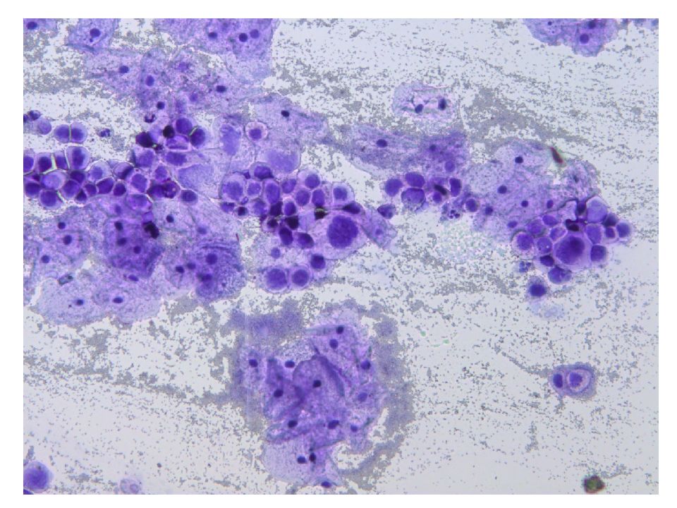 Аденокарцинома цитология. Базальноклеточный (базалиома)..