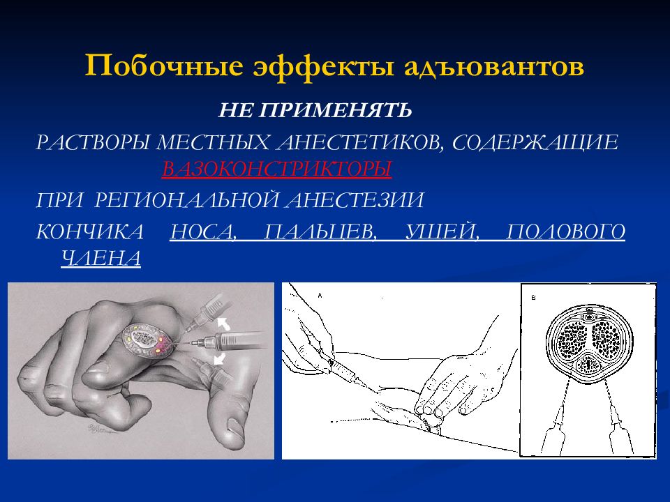 Проводниковая анестезия презентация