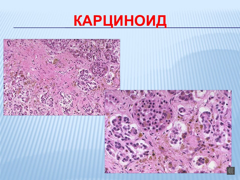 Презентация смешанные дистрофии