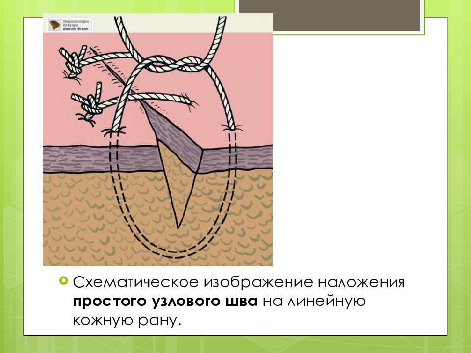 Швы сняты. Наложение узлового шва на рану. Шов кожный Узловой наложение.