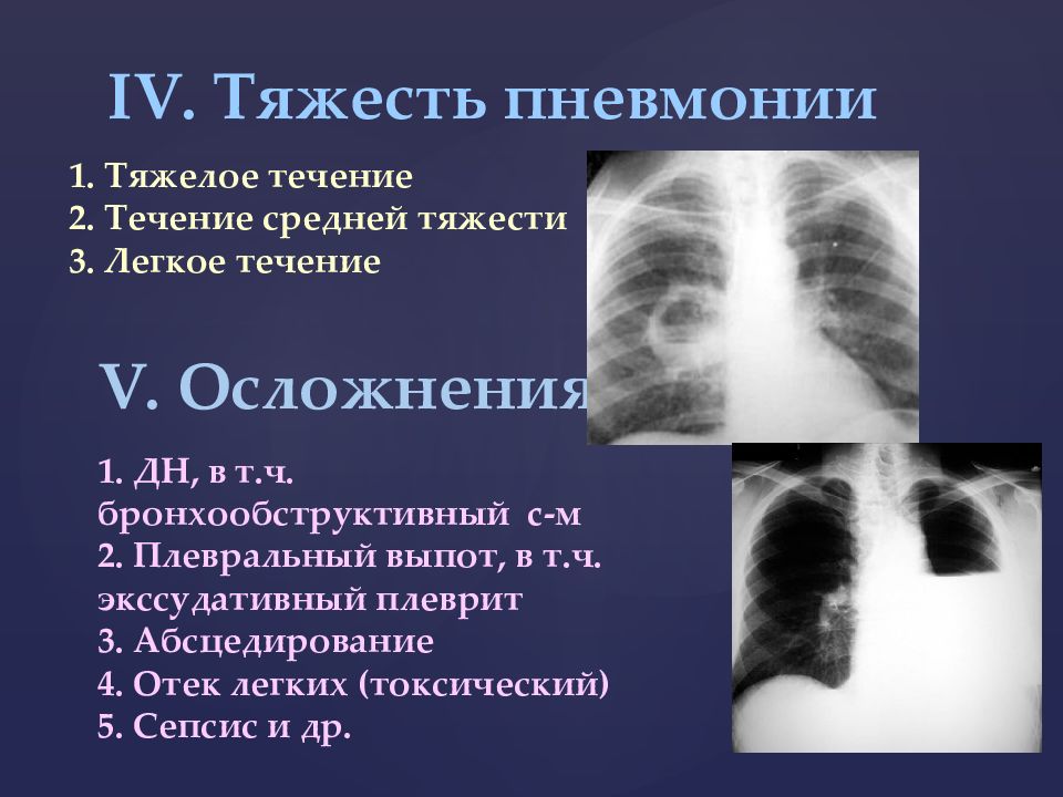 Легкое течение пневмонии. Воспаление лёгких средней тяжести. Тяжелая и средняя пневмония. Двухсторонняя пневмония.