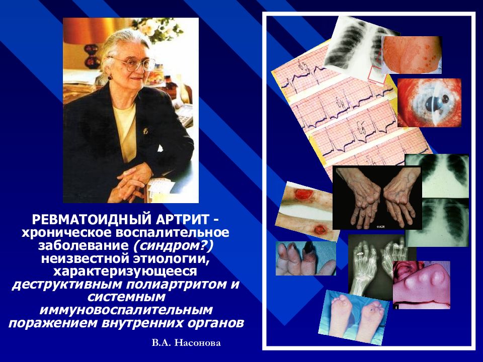 Ревматический и ревматоидный артрит разница Ревматический и ревматоидный артрит разница