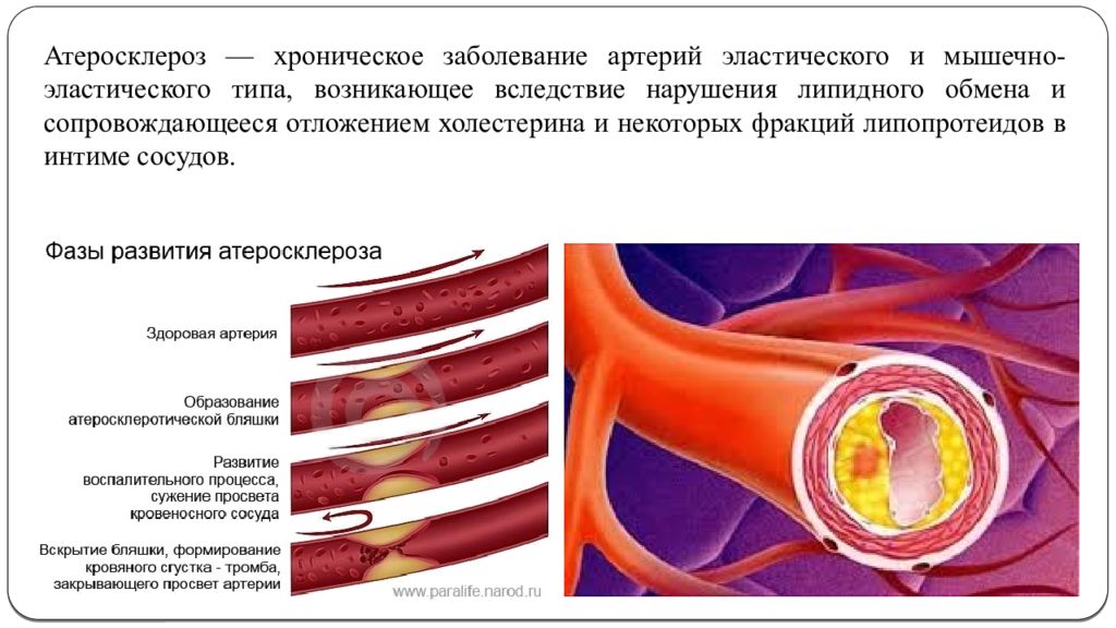 Распад сосудов. Патогенез атеросклероза сонной артерии. Атеросклеротическое поражение артерий. Атеросклероз заболевание артерий эластического. Артериальные бляшки в сосудах.