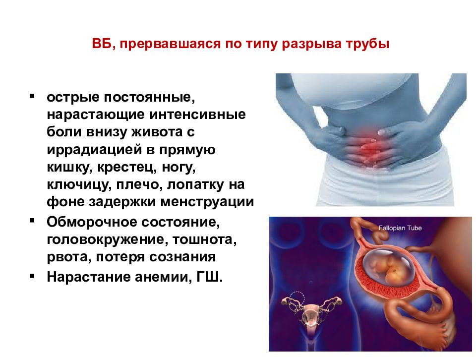 Острый живот в акушерстве презентация