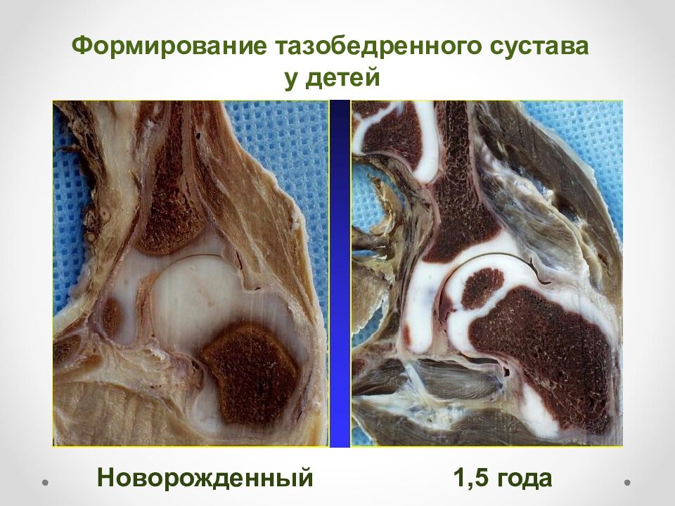 Формирование тазобедренного сустава у детей