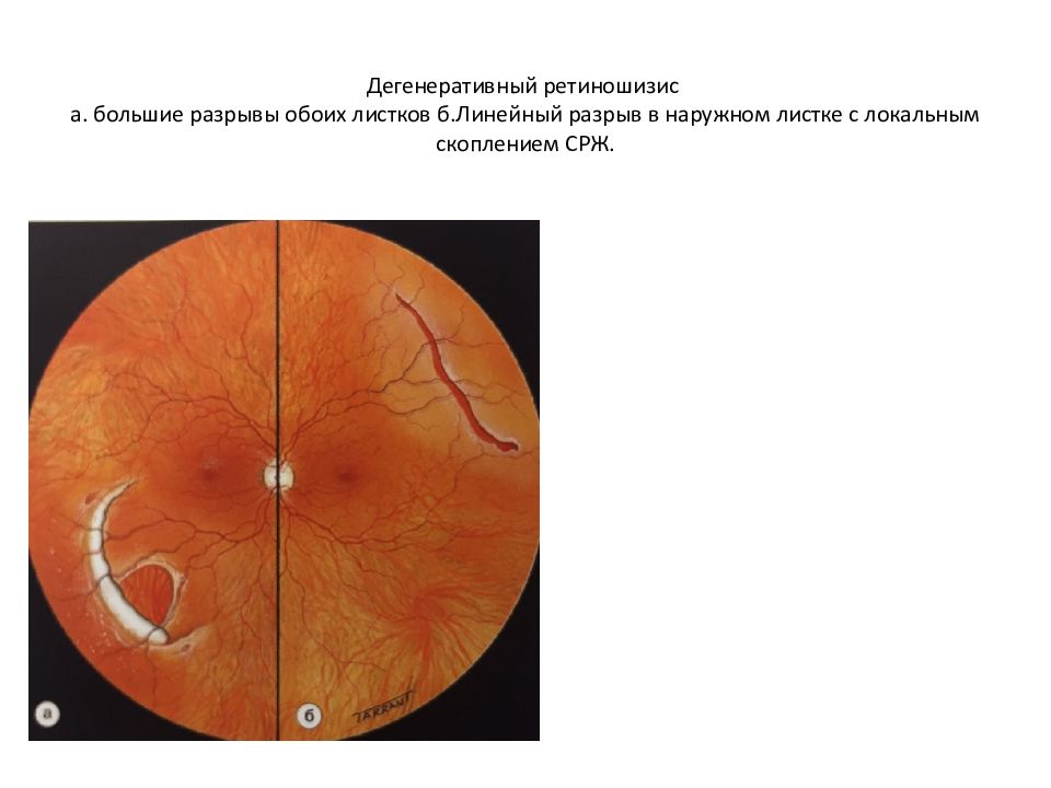 Отслойка сетчатки презентация. Разрыв сетчатки с локальной отслойкой. Х сцепленный ретиношизис. Периферический ретиношизис.