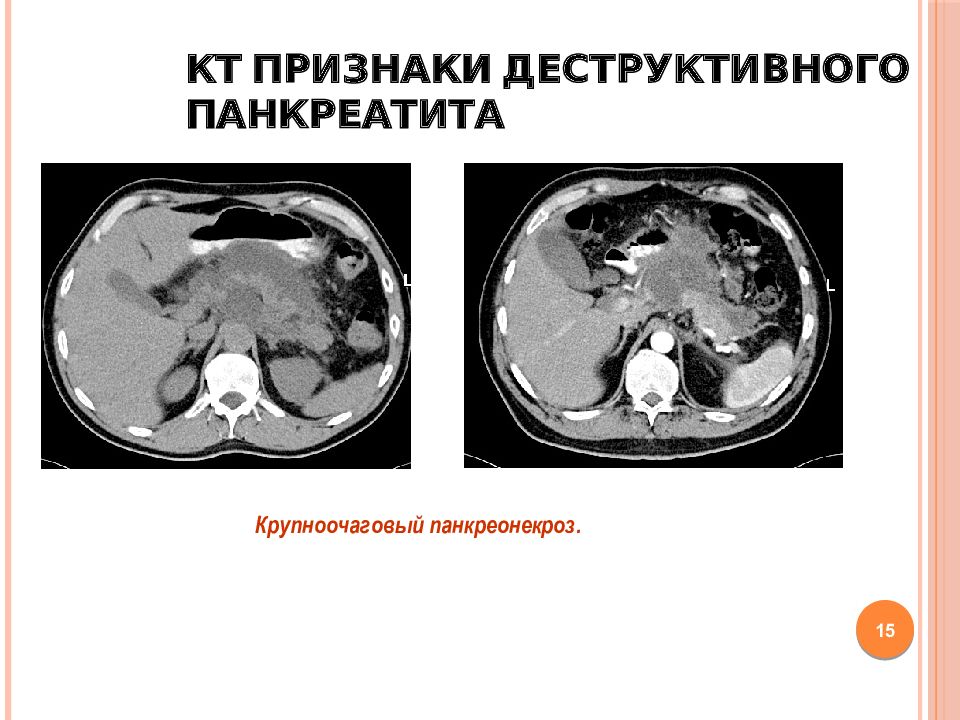 Отечный панкреатит. Панкреонекроз поджелудочной железы кт. Острый деструктивный панкреатит кт. Деструктивный панкреатит кт. Отечная форма панкреатита кт.