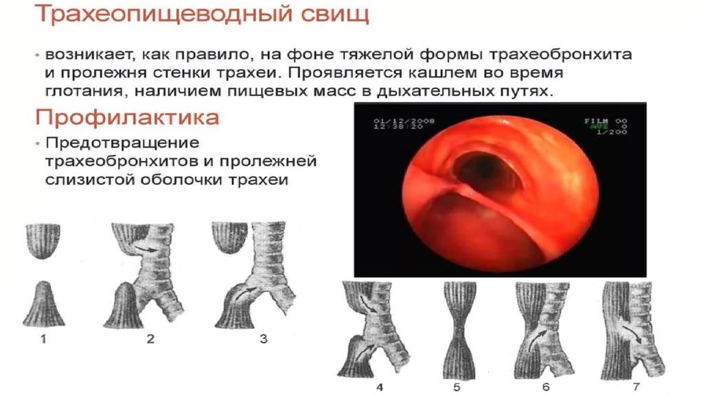 Заболевания диафрагмы презентация