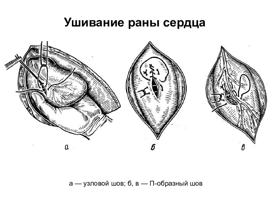 Сердечный ран. Ушивание раны сердца техника. Ушивание РАН сердца и легкого. Ушивание раны сердца топографическая анатомия. Ушивание раны сердца этапы операции.