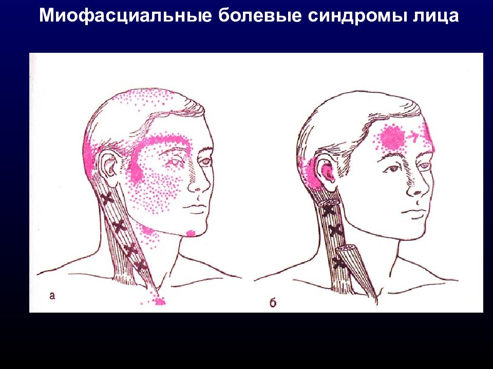 Миофасциальный болевой синдром. Миофасциальные болевые синдромы. Миофасциальный болевой синдром неврология. Лицевые миофасциальные синдромы.