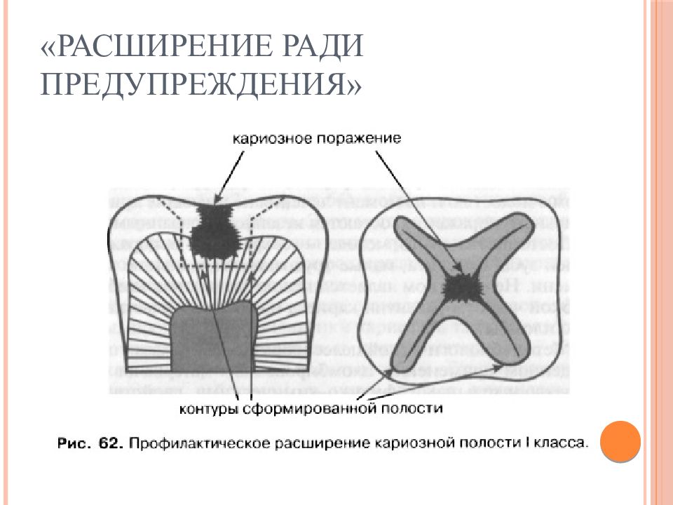 Элементы кариозной полости. Метод профилактического расширения кариозной полости предложил. Расширение кариозной полости 1 класса. Препарирование полостей 2 класса по Блэк профилактическое расширение.