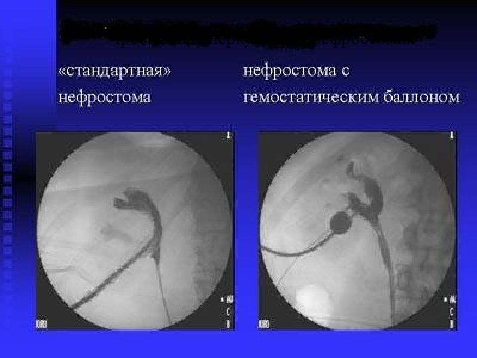 Пункционная нефростомия. Чрескожная перкутанная нефростомия. Перкутанная пункционная нефростомия. Чрескожная нефростомия почки.