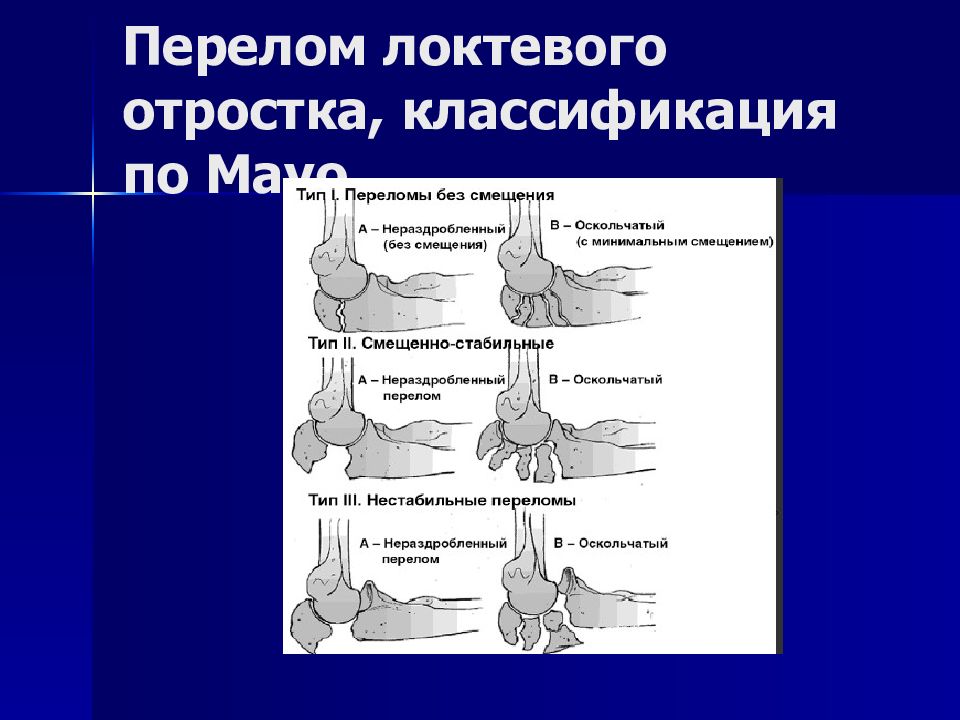 Перелом локтевого отростка. Переломы локтевого отростка классификация. Перелом локтеового отрсокта. Перелом локтевогототррстка классификация.