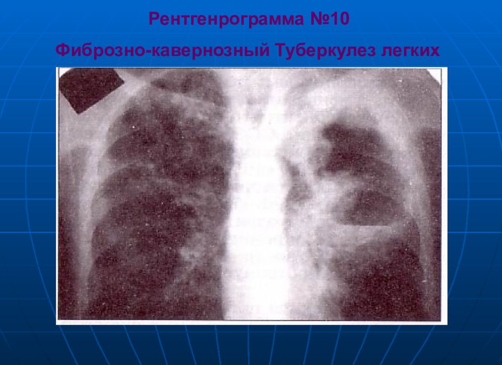 Каверна при туберкулезе. Фиброзно-кавернозный туберкулез рентген. Фиброзно-кавернозный туберкулез каверны. Каверна при туберкулезе на рентгене. Фибринозно-кавернозный туберкулёз рентген.