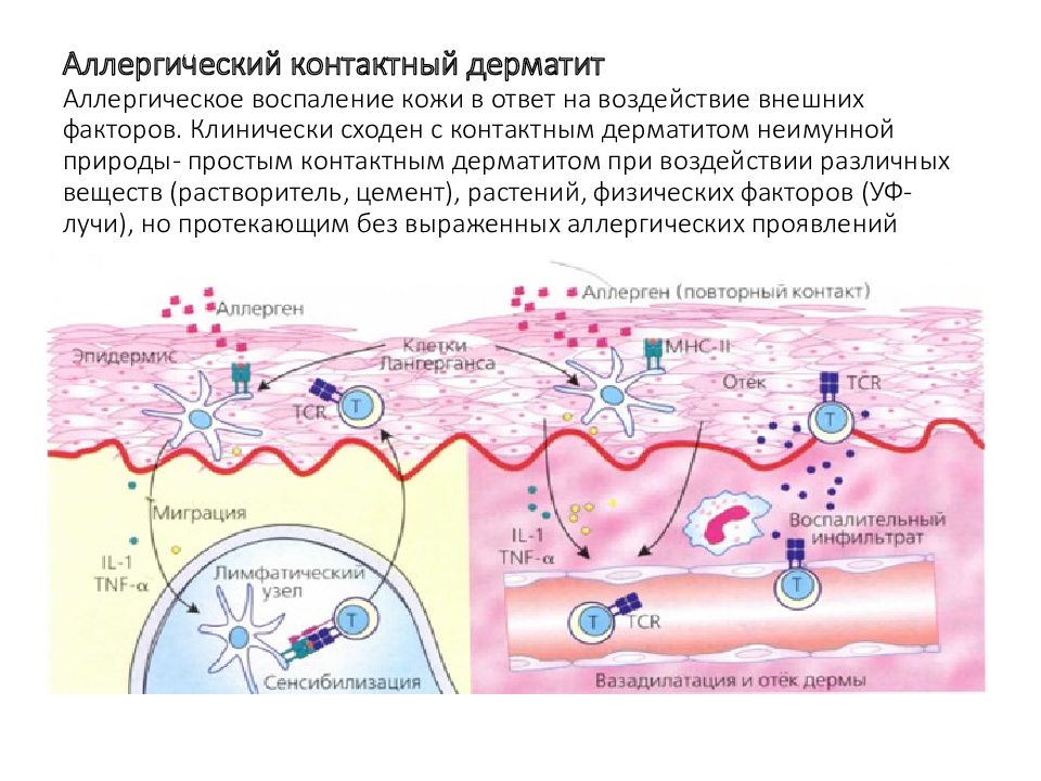 Аллергический контактный дерматит презентация