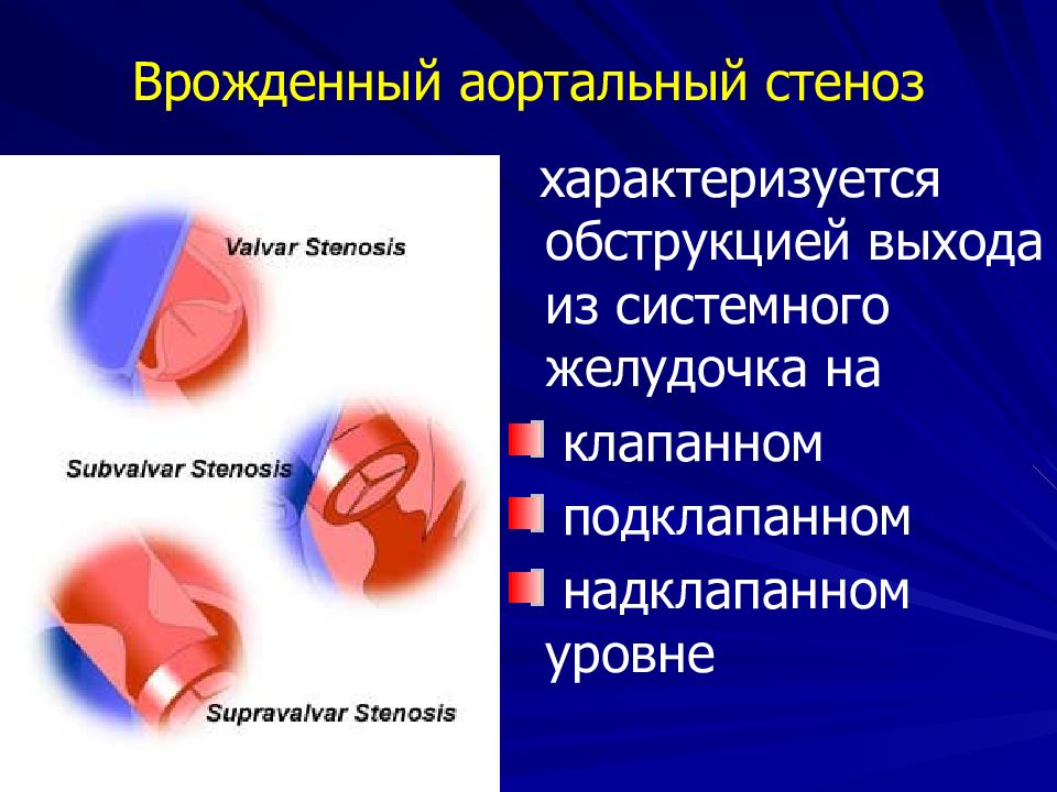 Аортальный градиент. ВПС стеноз аортального клапана. Подклапанный клапанный надклапанный стеноз аорты. Врожденный надклапанный стеноз аорты. Подклапанный стеноз аортального клапана.