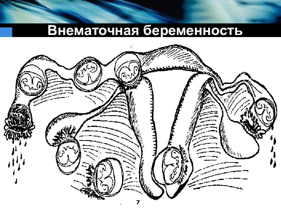 Эктопическая беременность презентация