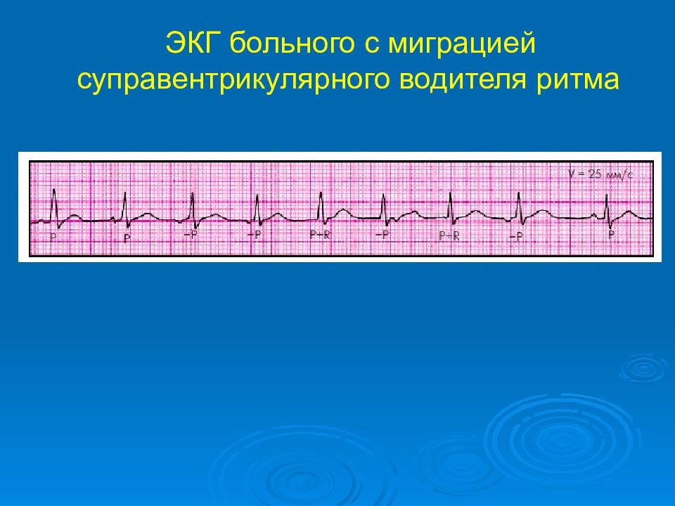 Миграция ритма. Миграция суправентрикулярного ритма на ЭКГ. Суправентрикулярный водитель ритма миграция. Миграция суправентрикулярного водителя ритма на ЭКГ. Суправентрикулярный ритм на ЭКГ.