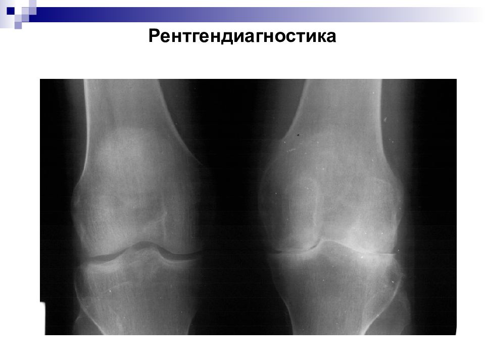 Ювенильный ревматоидный артрит. Ювенинильный ревматоидный артрит. Ювенильный ревматоидный артрит коленного сустава рентген. Ювенильный артрит коленного сустава рентген.
